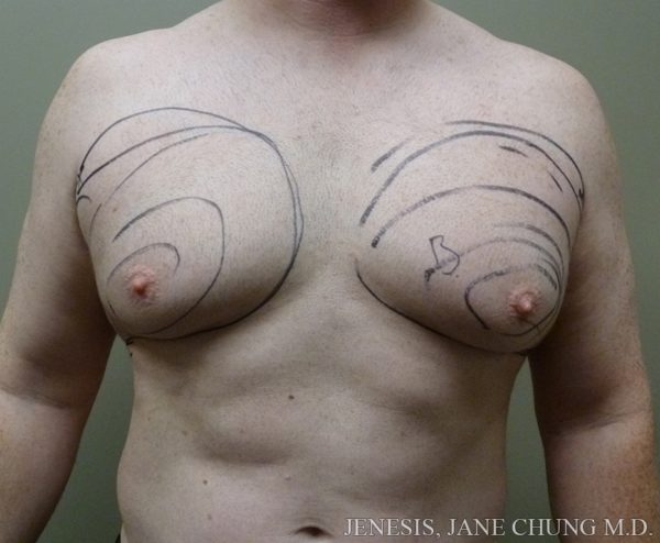 Vaser Gynecomastia Before and After Results