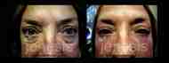 Filler 21 nggid03780 ngg0dyn 190x71x100 00f0w010c011r110f110r010t010 Dark Circle Treatment