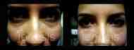 Filler 5 nggid03782 ngg0dyn 190x71x100 00f0w010c011r110f110r010t010 Dark Circle Treatment