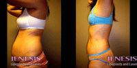 Liposelection
