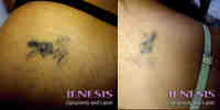 tatoo removal 3 Laser Tattoo Removal